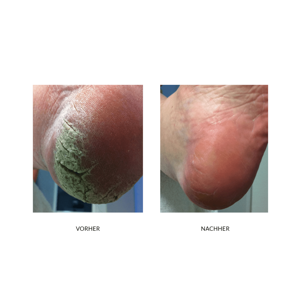 6515739c0cdc425925bf6ad561720fa3_callus_vorhernachher_2